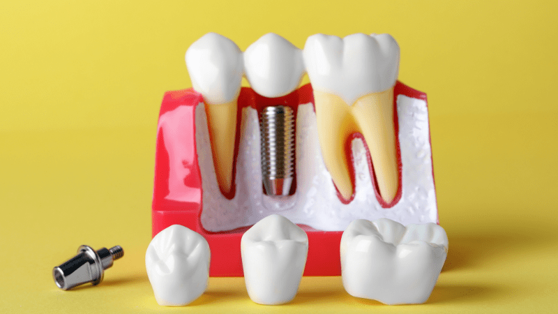 bọc răng sứ chất lượng cao