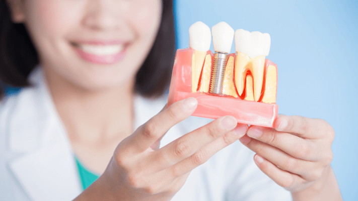 Trồng răng implant uy tín an toàn