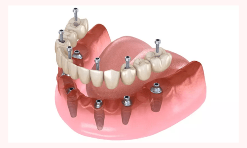 Cấy ghép Implant All On 6 trong trồng răng sứ