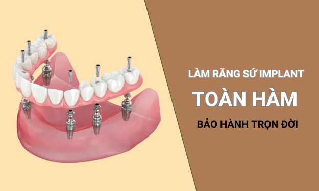 Bảng giá làm răng sứ Implant toàn hàm