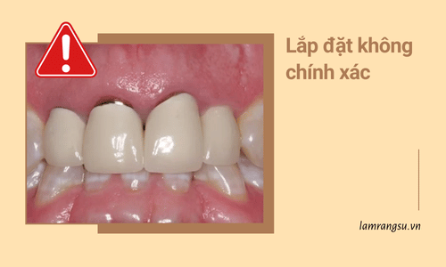 Làm răng sứ bị hỏng do lắp đặt không chính xác