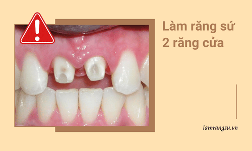 Những ai cần làm răng sứ 2 răng cửa ?