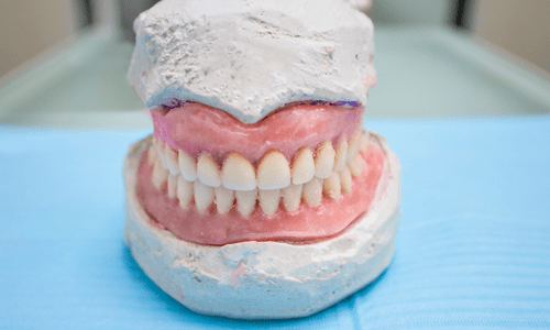 nhiễm trùng khi bọc răng sứ