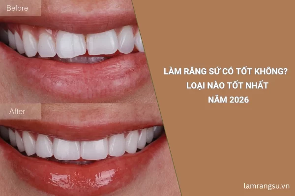 làm răng sứ tốt nhất