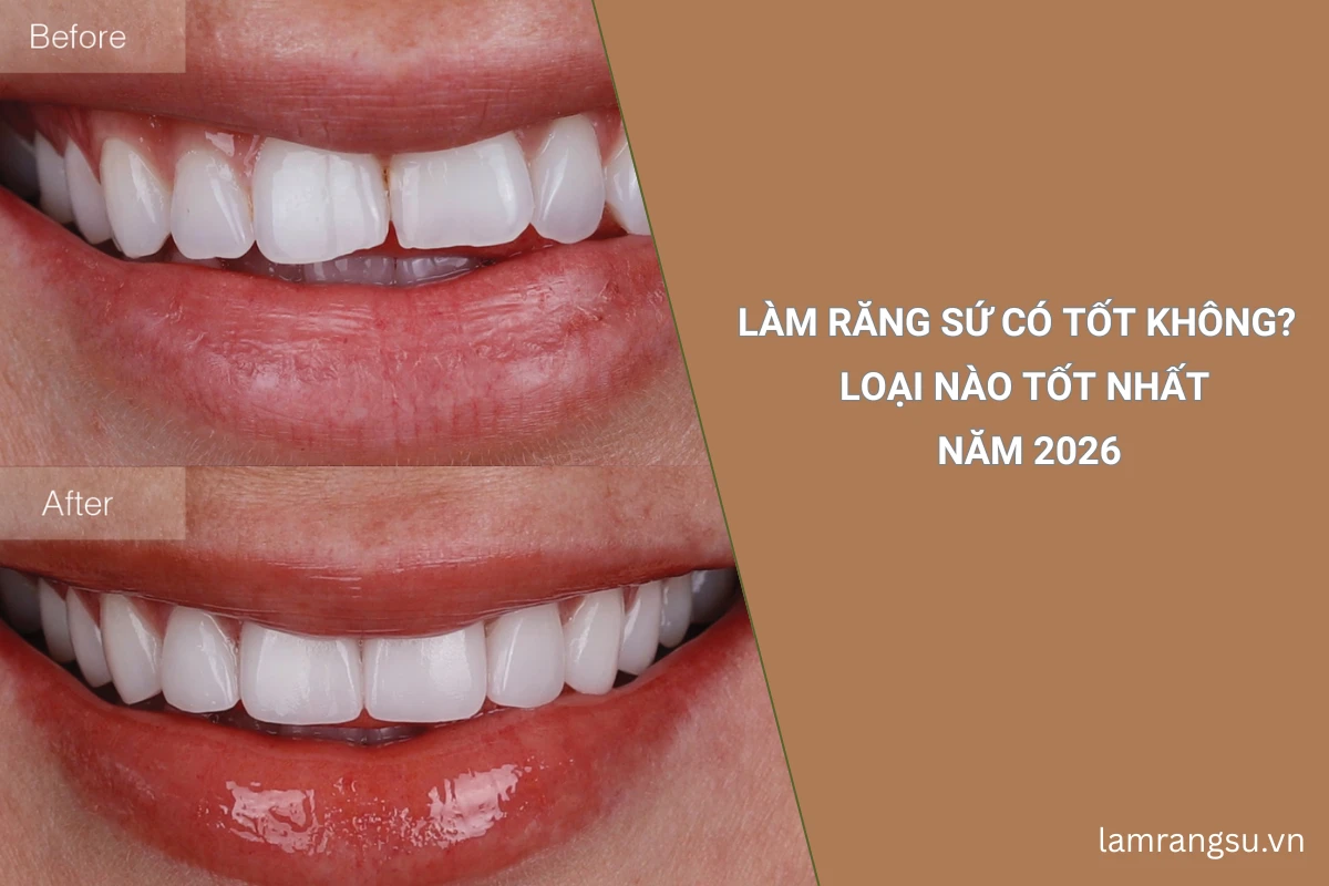 làm răng sứ tốt nhất