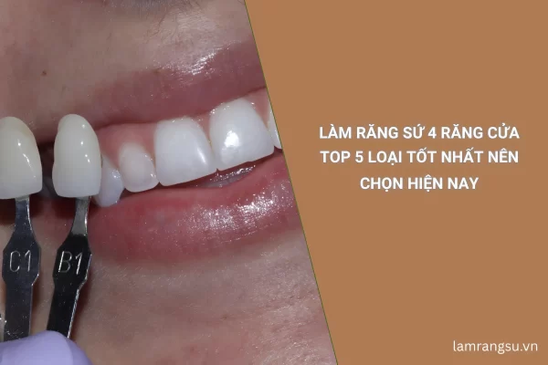 làm răng sứ 4 răng cửa
