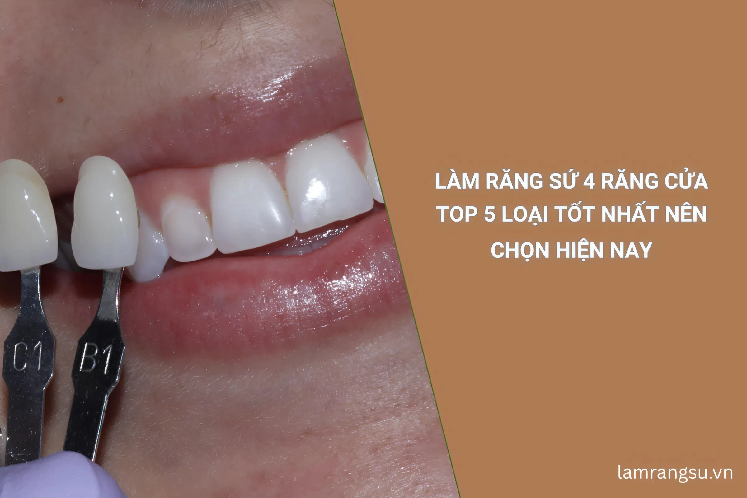 làm răng sứ 4 răng cửa