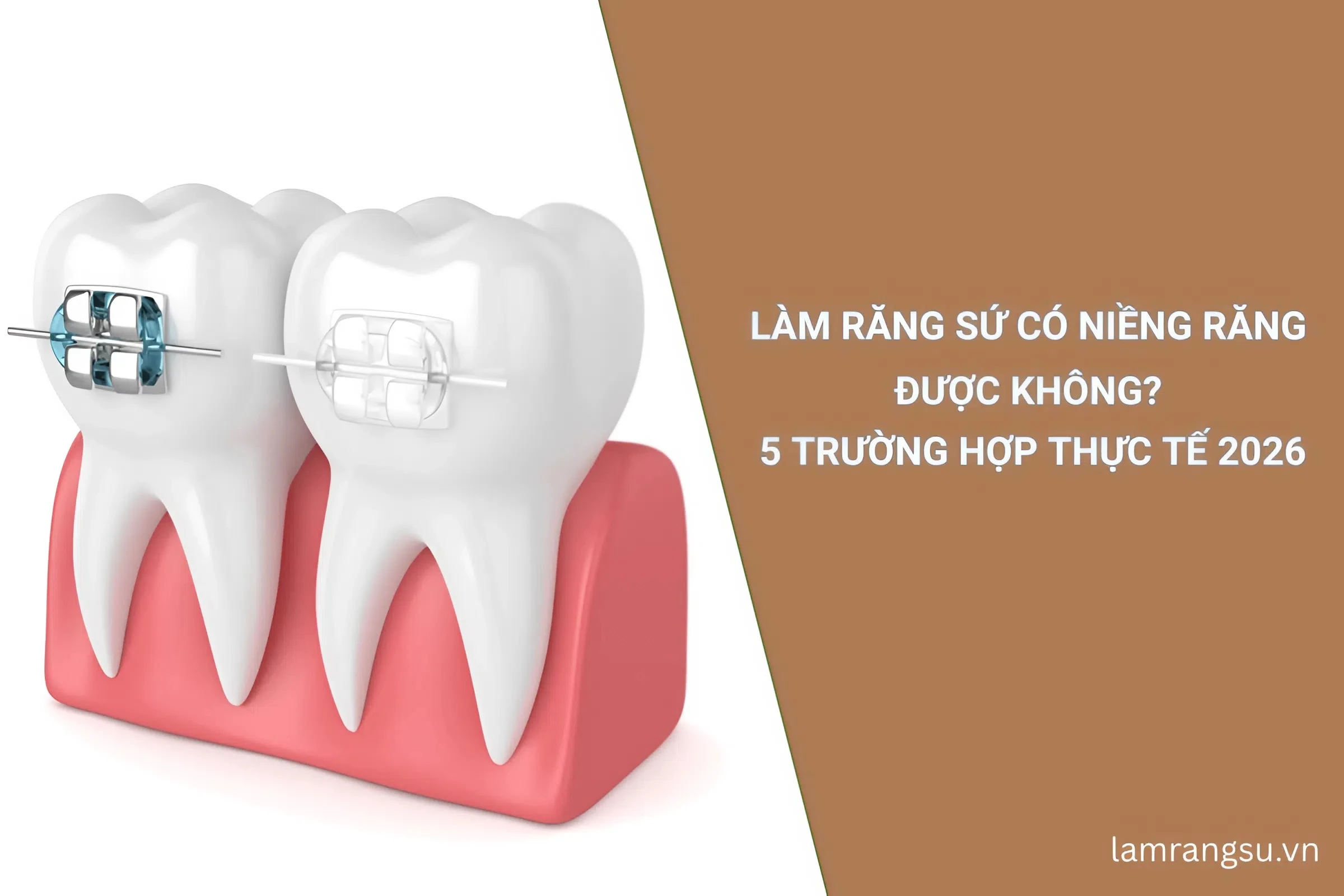 làm răng sứ có niềng răng được không